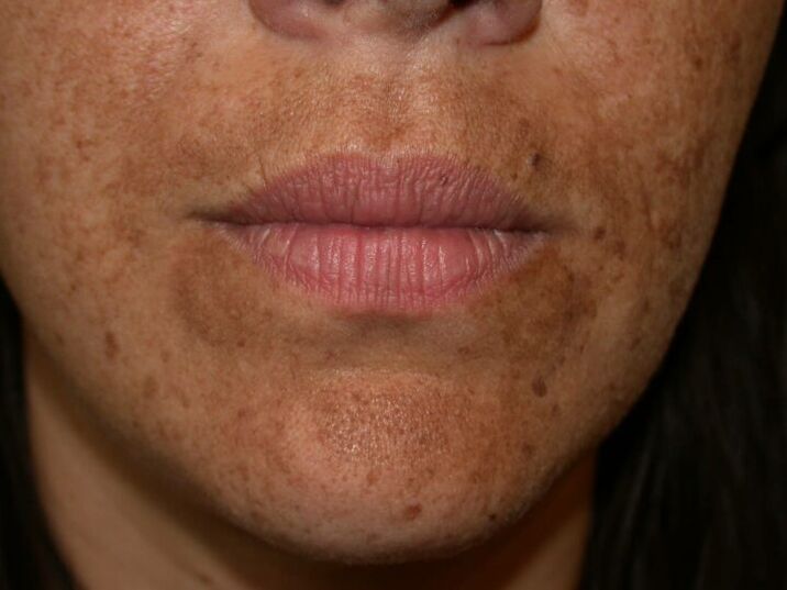 As manchas pigmentadas na cara son unha indicación para un procedemento con láser