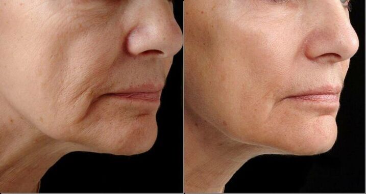 Pel facial antes e despois do procedemento de rexuvenecemento por láser