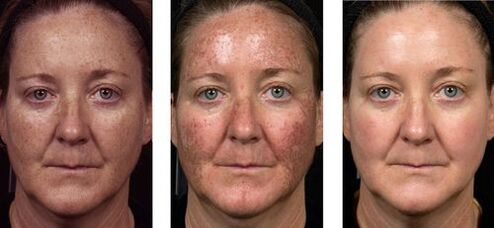 antes e despois do rexuvenecemento da pel fraccionado foto 2