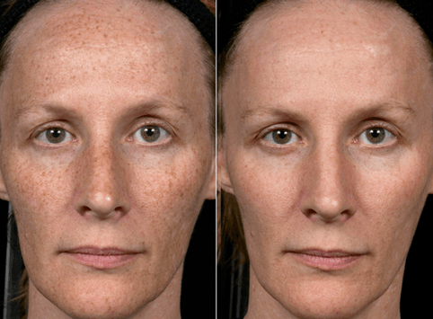 antes e despois do rexuvenecemento da pel fraccionado foto 3