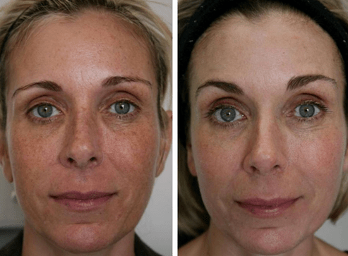 antes e despois do rexuvenecemento da pel fraccionado foto 4