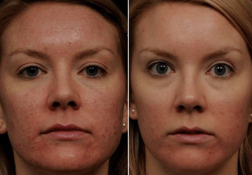 antes e despois do rexuvenecemento da pel fraccionado foto 6