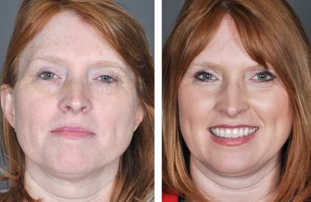 Procedemento de rexuvenecemento facial antes e despois dunha serie de procedementos