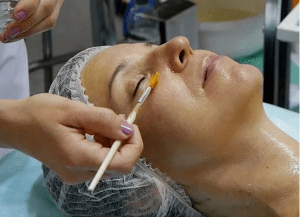 Peelado químico