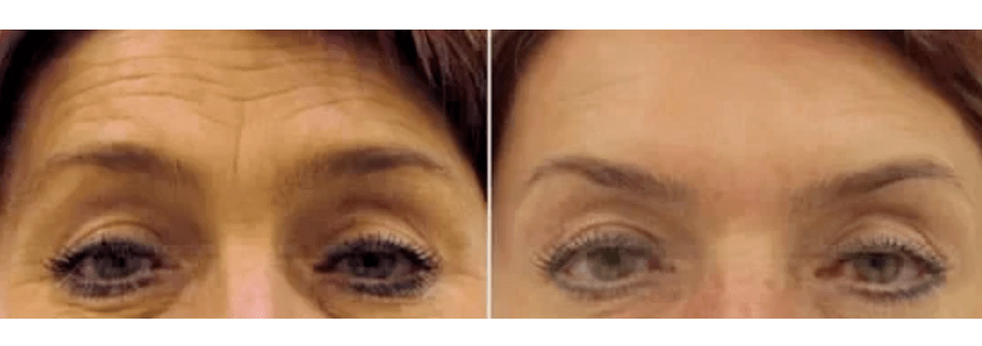 dispositivos para o rexuvenecemento fraccionado